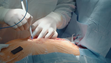 surgeon works with laser scalpel in clinic closeup. cardio surgeon opens way to patient heart with modern cutter in hospital. coronary artery bypass surgery