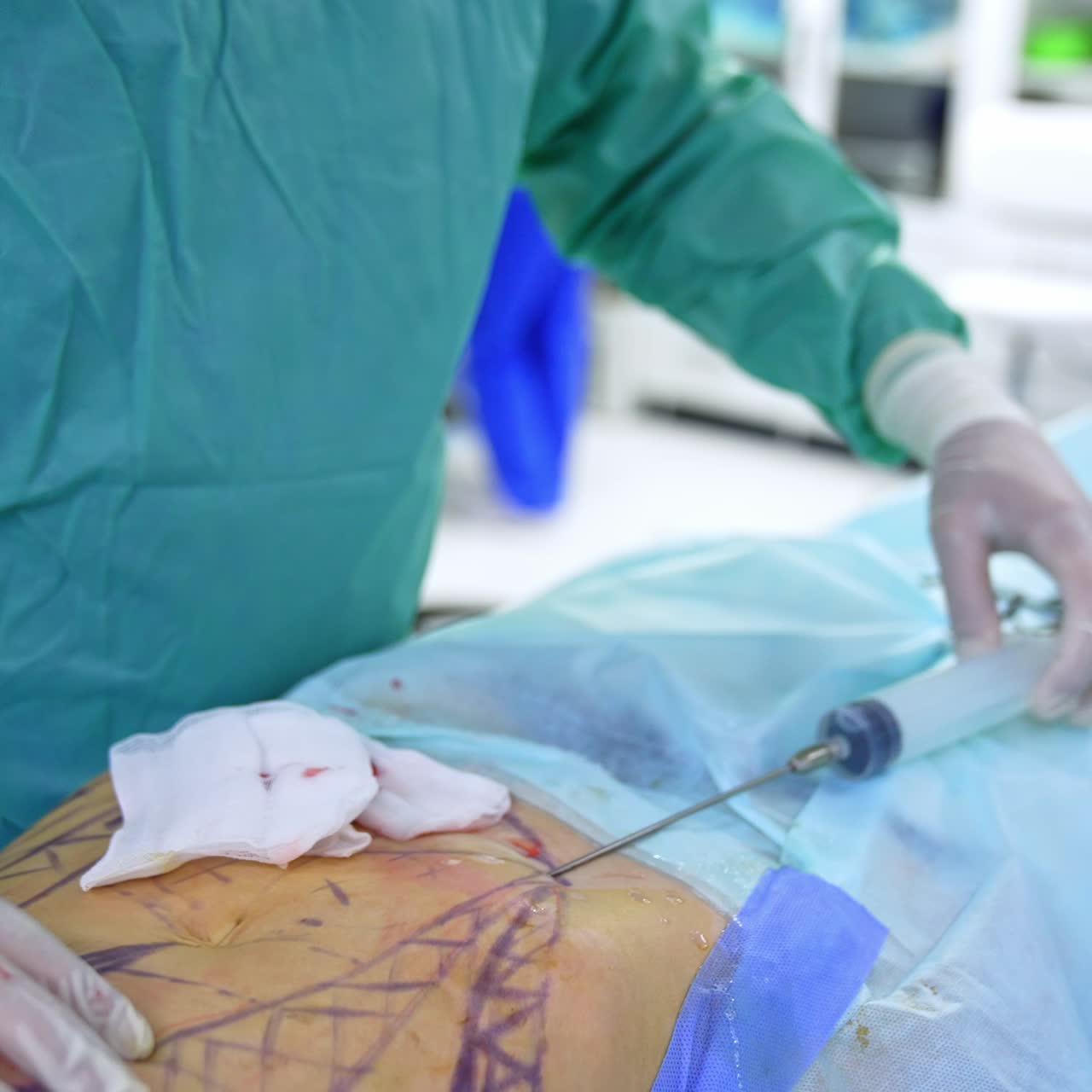 Il medico inietta farmaci nell'addome del paziente con l'aiuto di una grande siringa. Liposuzione addominale femminile.