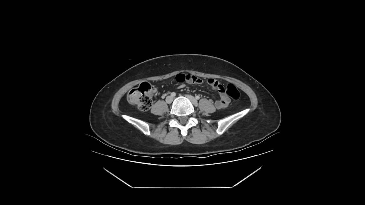 Ct scan results for appendicitis and gallstones in patients diagnostic imaging analysis hospital setting