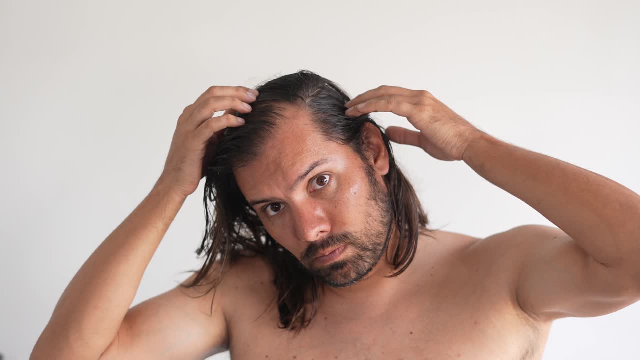 Male pattern baldness, man with hair loss problems, Derma Roller For Hair Loss, stop balding, Alopecia, Hair shedding, Scalp issues, Hair fall