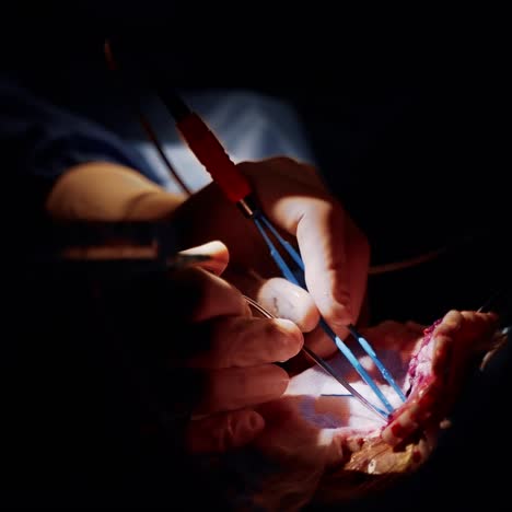 laparoscopic surgery on dark background. hands in surgical gloves perform a neurosurgery using medical tools. close-up.