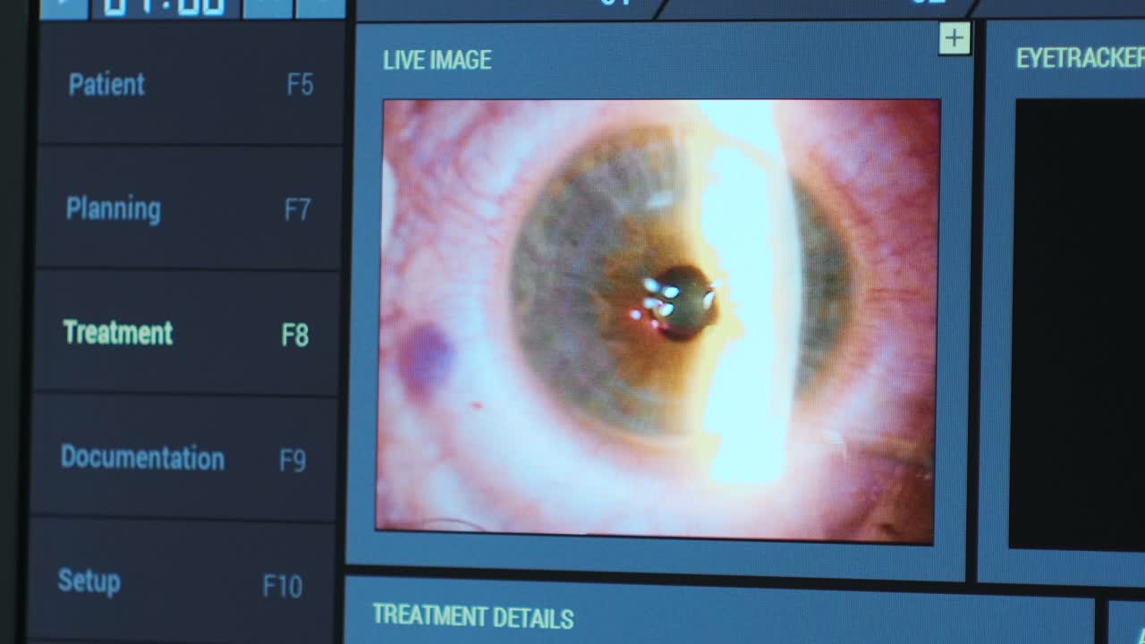 Ophthalmic surgery. View on the screen of medical monitor in operating room. Lasik