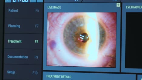 ophthalmic surgery. view on the screen of medical monitor in operating room. lasik