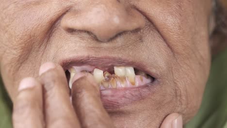 dental issues in elderly woman