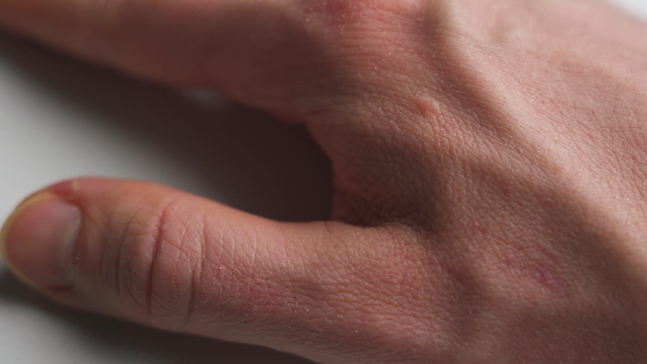 Close-up view of a hand with a skin rash