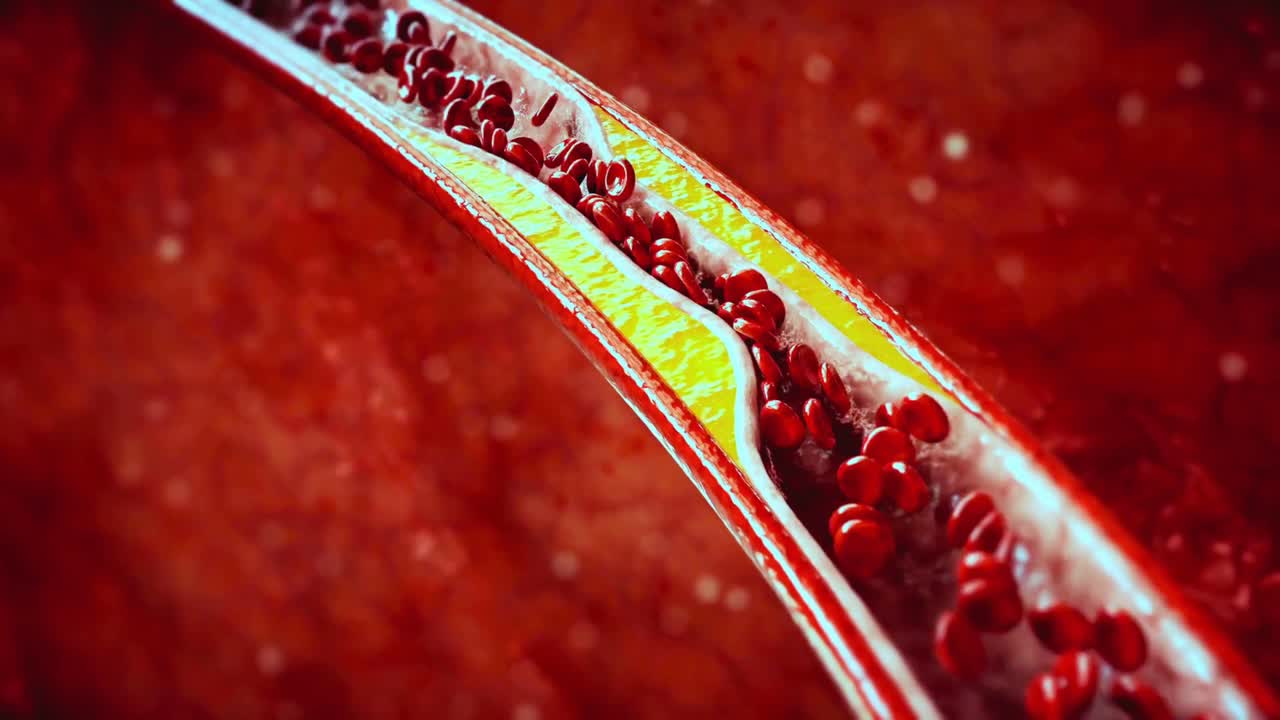 Atherosclerosis Plaque Accumulating and Narrowing a Blood Vessel