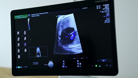 ultrasound image of a fetus