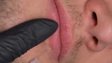 lip filler procedure