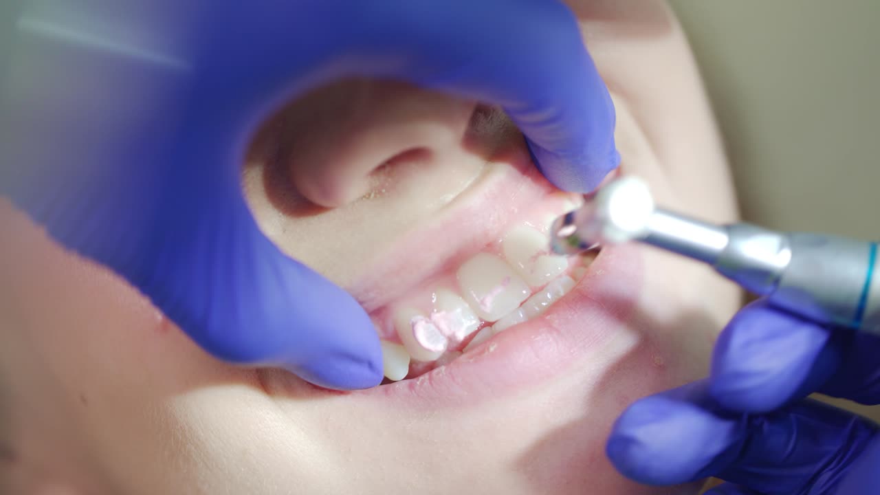 Teeth polishing procedure. Dentist hands working with dental high speed drill