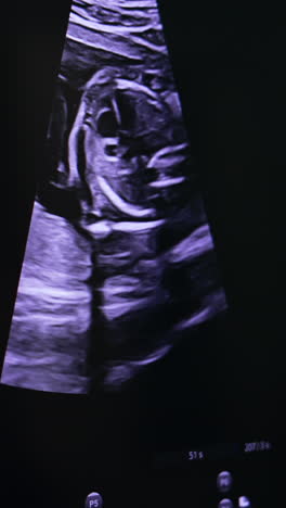 ultrasound scanning of pregnancy. checking up the development of a baby before birth.. vertical video