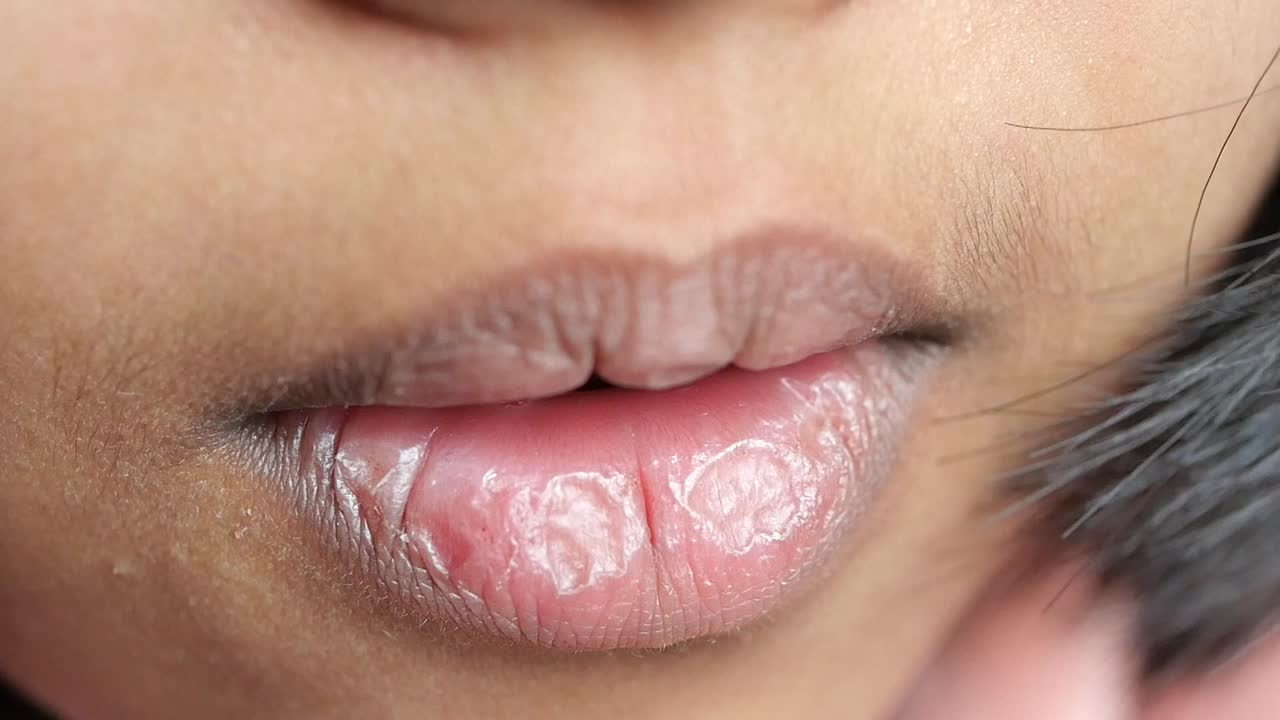 primer plano de los labios de una persona con una posible condición seca o agrietada
