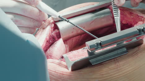 doctor operates on open heart with laser scalpel. surgeon uses fine forceps to navigate coronary arteries in sterile environment with intense focus