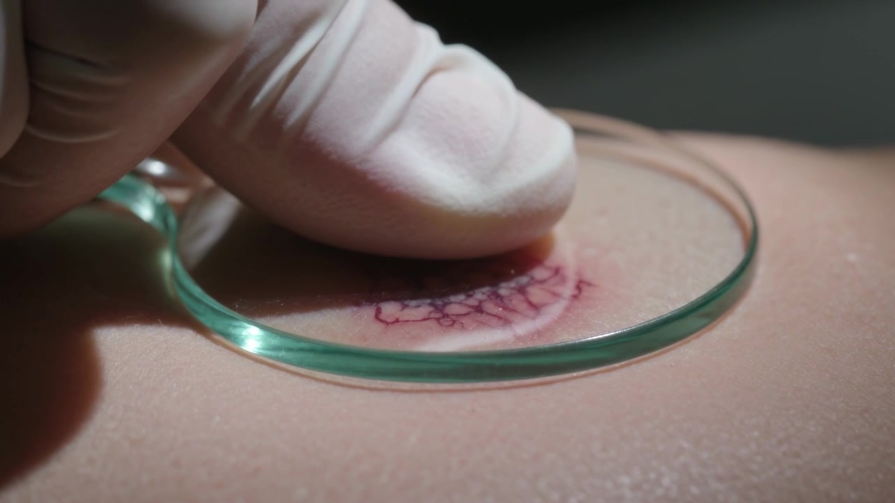Posizionando una mano guantata e un disco di vetro su una lesione cutanea in clinica, comprimendo per rivelare materiale scuro.