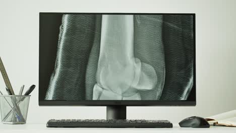 medical x-ray of a knee injury