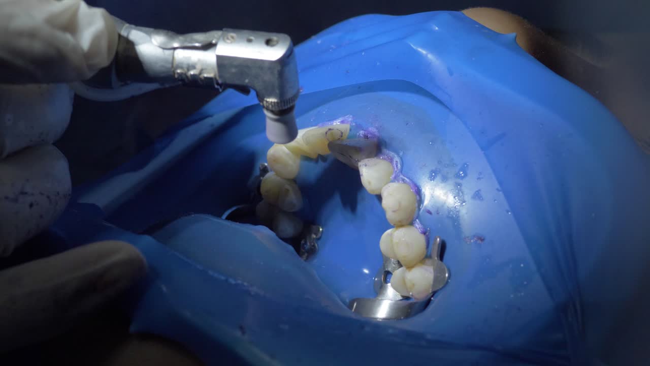 치아를 폴리셔로 는 것