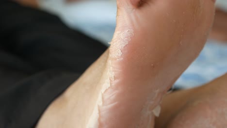 peeling skin on feet