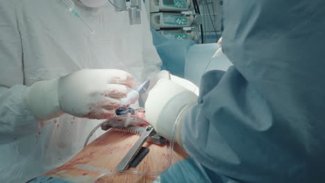 surgeon attaches graft vessels operating. experienced medic performs complicated coronary artery bypass graft surgery with assistant in operating room