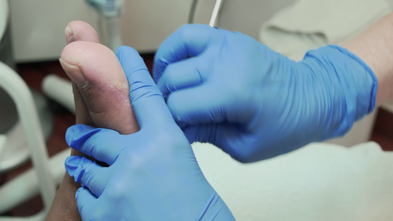 Podologia: rimozione di pelle morta e calli dalla pianta del piede sinistro.