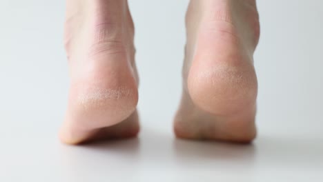 close-up of dry, cracked heels
