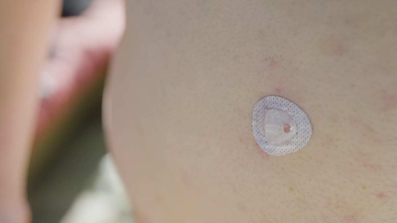 Detailed close-up of a hand adjusting an insulin infusion set on the body. Highlights diabetes care and medical technology in use.