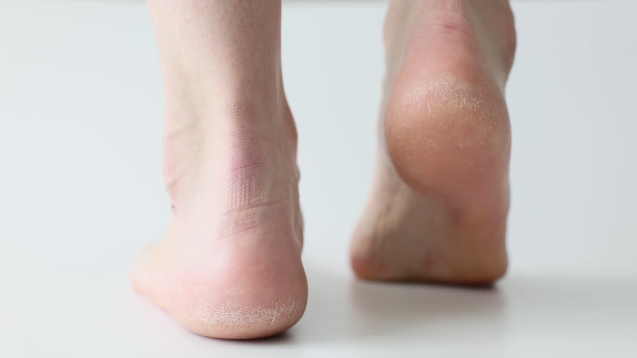 Cracked Heels and Dry Skin