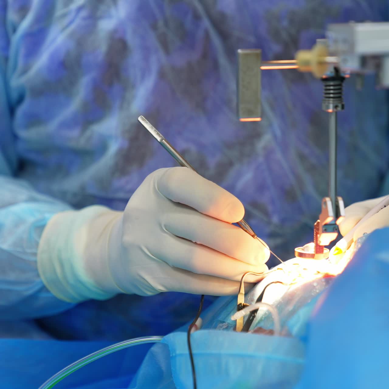 Gloved hand of a doctor uses metal tool at eye surgery. Close up. Device hanging over the patient emits bright light