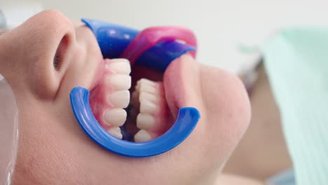 cosmetic teeth whitening treatment in progress at professional dental office