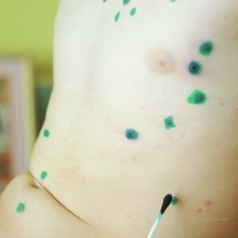 baby with chicken pox. close-up square video