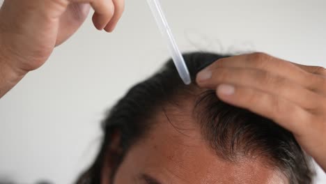 Mann,-Der-Minoxidil-Mit-Einer-Pipette-Ins-Haar-Einträgt,-Kahlheit,-Dünner-Werdendes-Haar