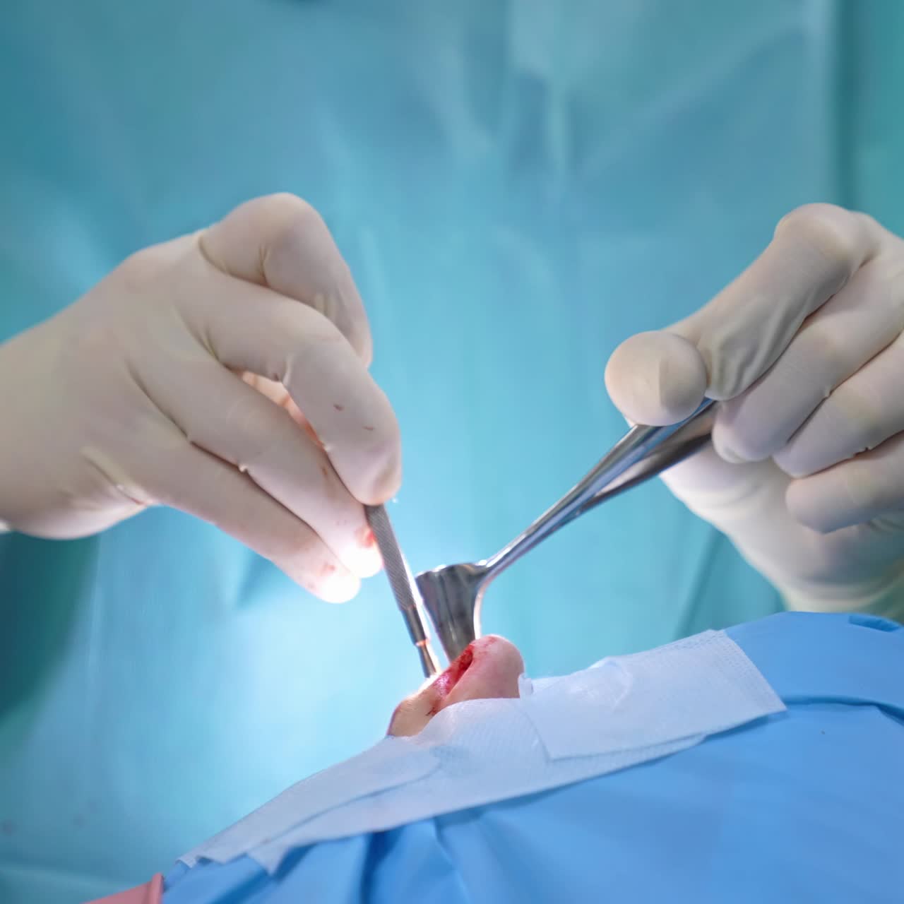 Surgical procedure in a nose. Surgeon using sterile surgical instrument while performing nasal operation to a patient. Close-up