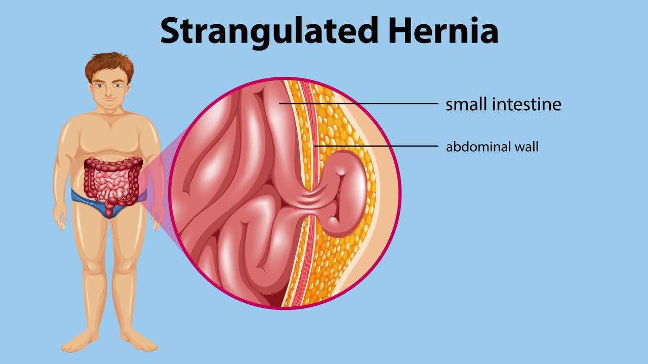 질식한 헤르니아 의학적 일러스트레이션