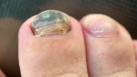 black toenail, toenail with fungal infection. sick nail.