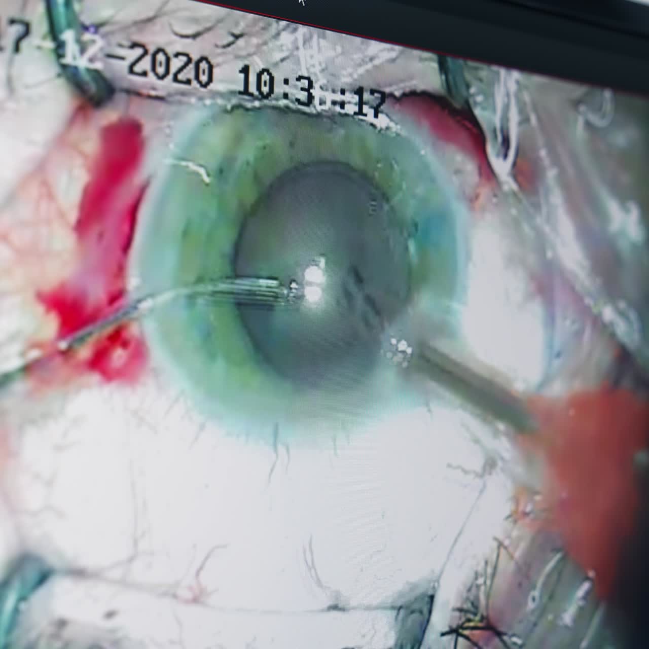 Eye with ophtalmology surgery tools. Surgery operation in modern clinic. Vision correction surgical treatment