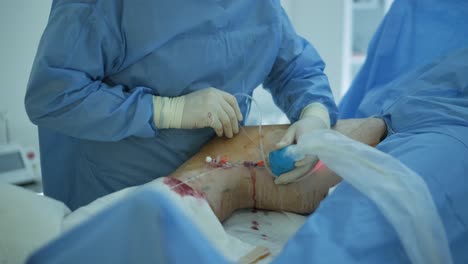 aplicación de bioglue en el tratamiento quirúrgico de la úlcera de la pierna