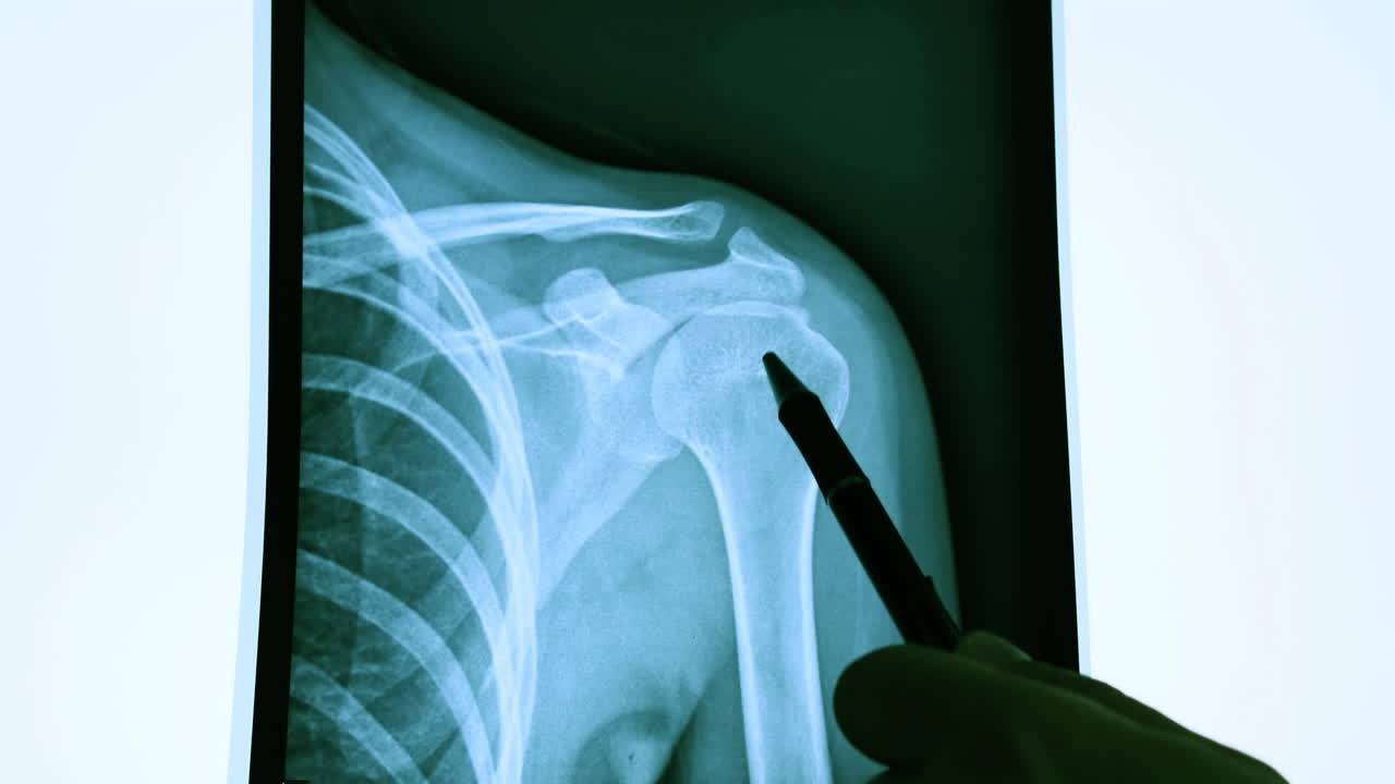 X-ray Scan a Healthy Shoulder Medical Diagnosis Doctor Analyzing a Damaged Bone 4k