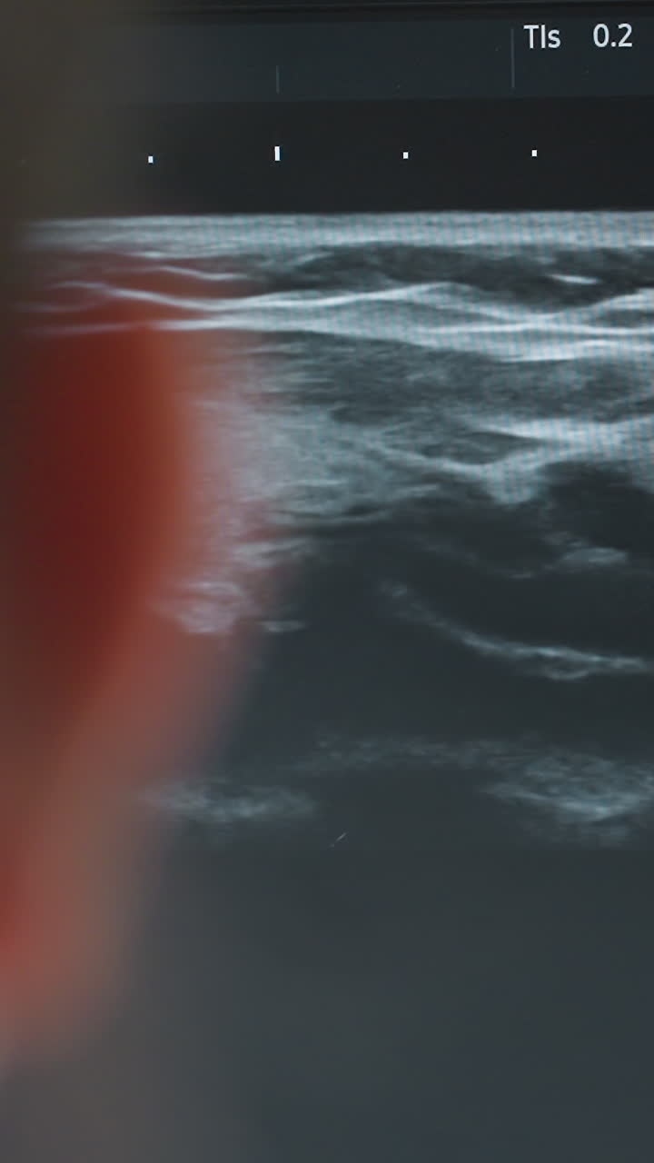 ultrasound monitor displaying soft nodule on grayscale sonogram, caucasian patient scan with clinician fingertip blurred in foreground crosssectional imaging shows hypoechoic rounded mass