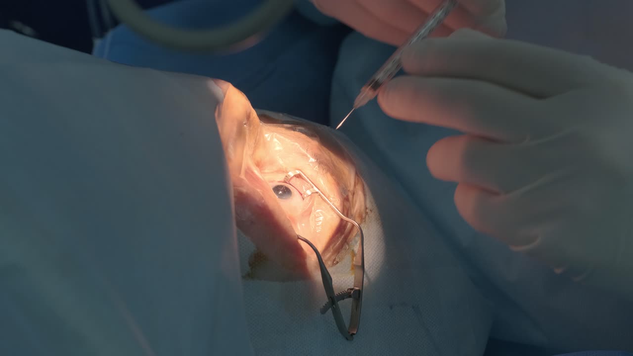 백내장 수술 (close-up) - 병원 수술에서 눈 백내장을 수술하는 외과 의사