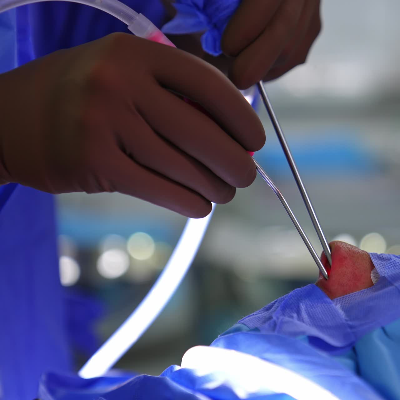 Instruments are input into nasal cavity by gloved hands of surgeon. Rhinoplasty operation for breathing restoration. Close up