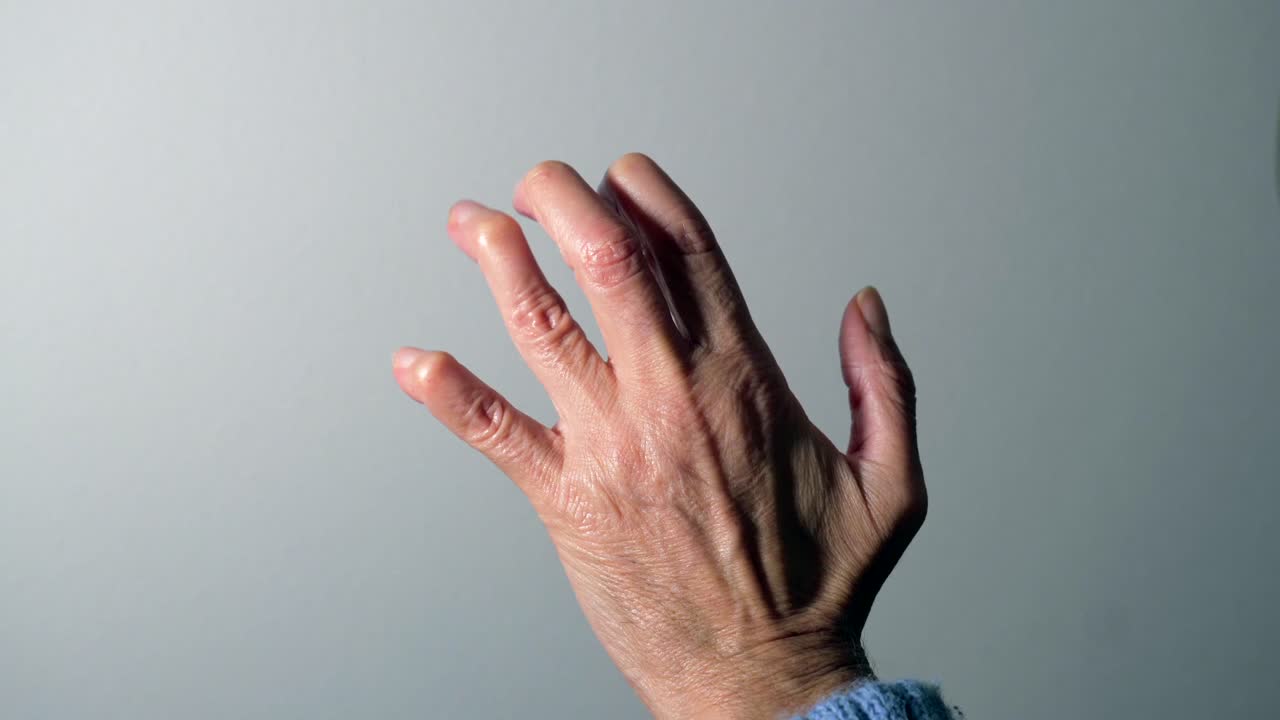 Hand with Arthritis