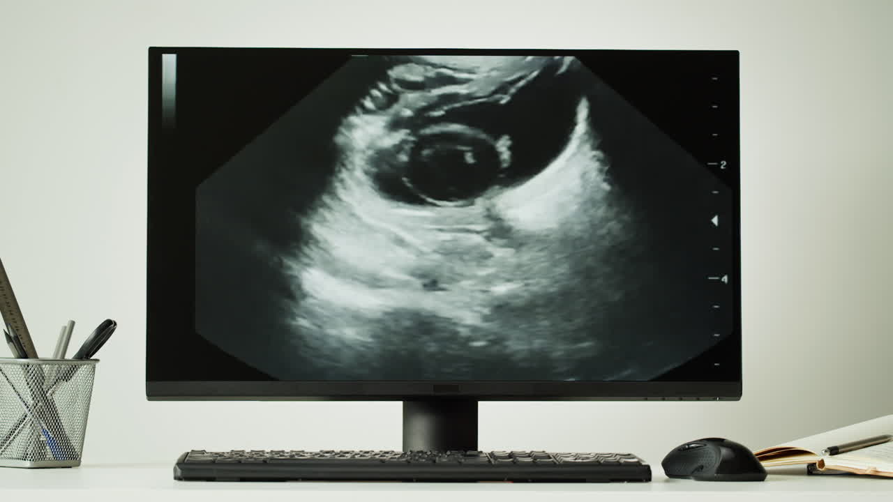 Immagine ecografica su monitor di computer