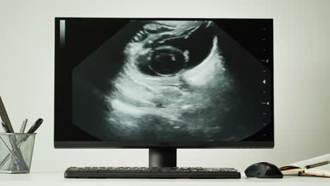 ultrasound image on computer monitor