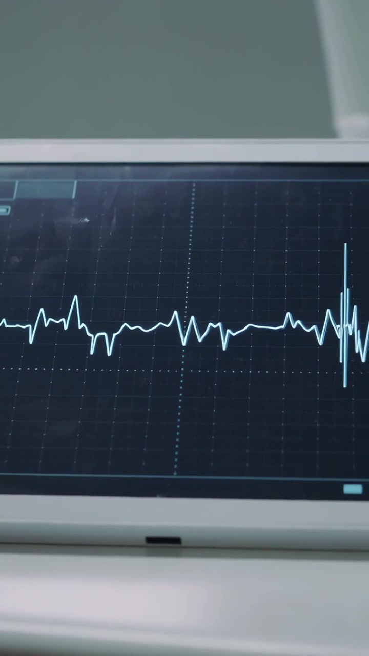 Video verticale: Che mostra la traccia ECG di un monitor che passa da un'irregolarità a un'esplosione di picchi in clinica.