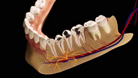 los dientes molares dañados por la caries. animación 3d del diente médicamente precisa