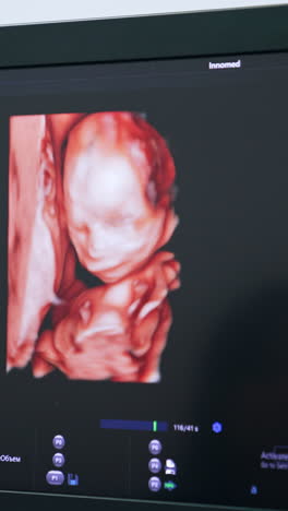 image of a child in mom's womb on the monitor of ultrasound machine. checking the baby development on the ultrasonic equipment. close up. vertical video
