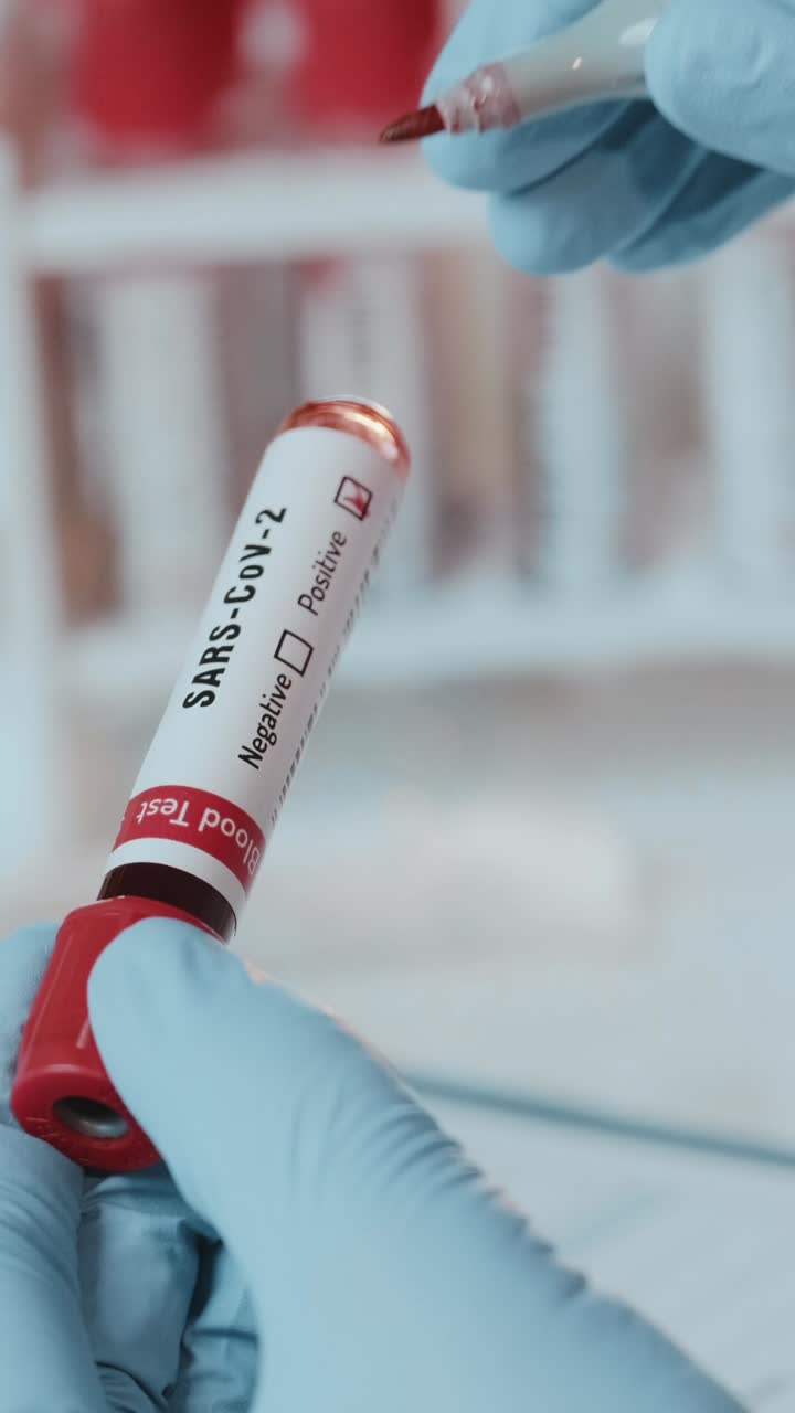 un profesional de la salud lleva a cabo un análisis de sangre de sars-cov2 en el laboratorio