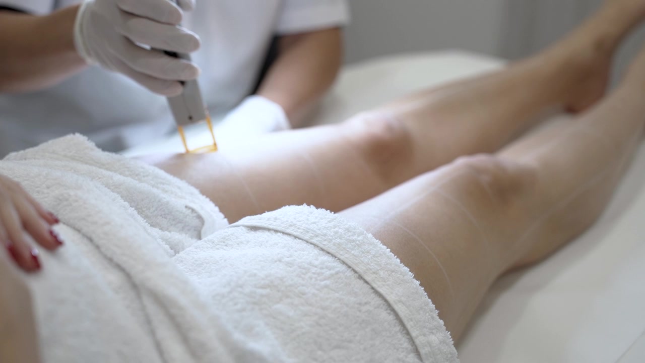Trattamento di epilazione laser Apotrixosi sulle gambe femminili - Primo piano