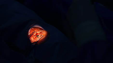 ophtalmology surgeon provide operation on eye with ophtalomological surgery tools. dark bakground and selective light.
