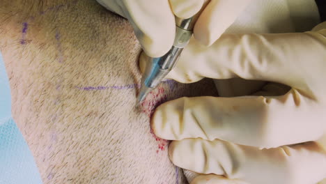 extraction of beard hair with an extraction machine for hair transplantation on the head using the fue technique