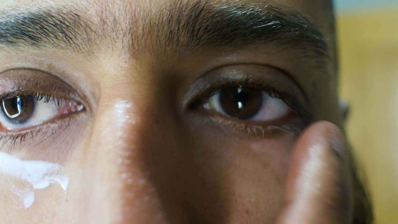Southeast Asian Indian Man applying eye cream to vitiligo areas on eye lids