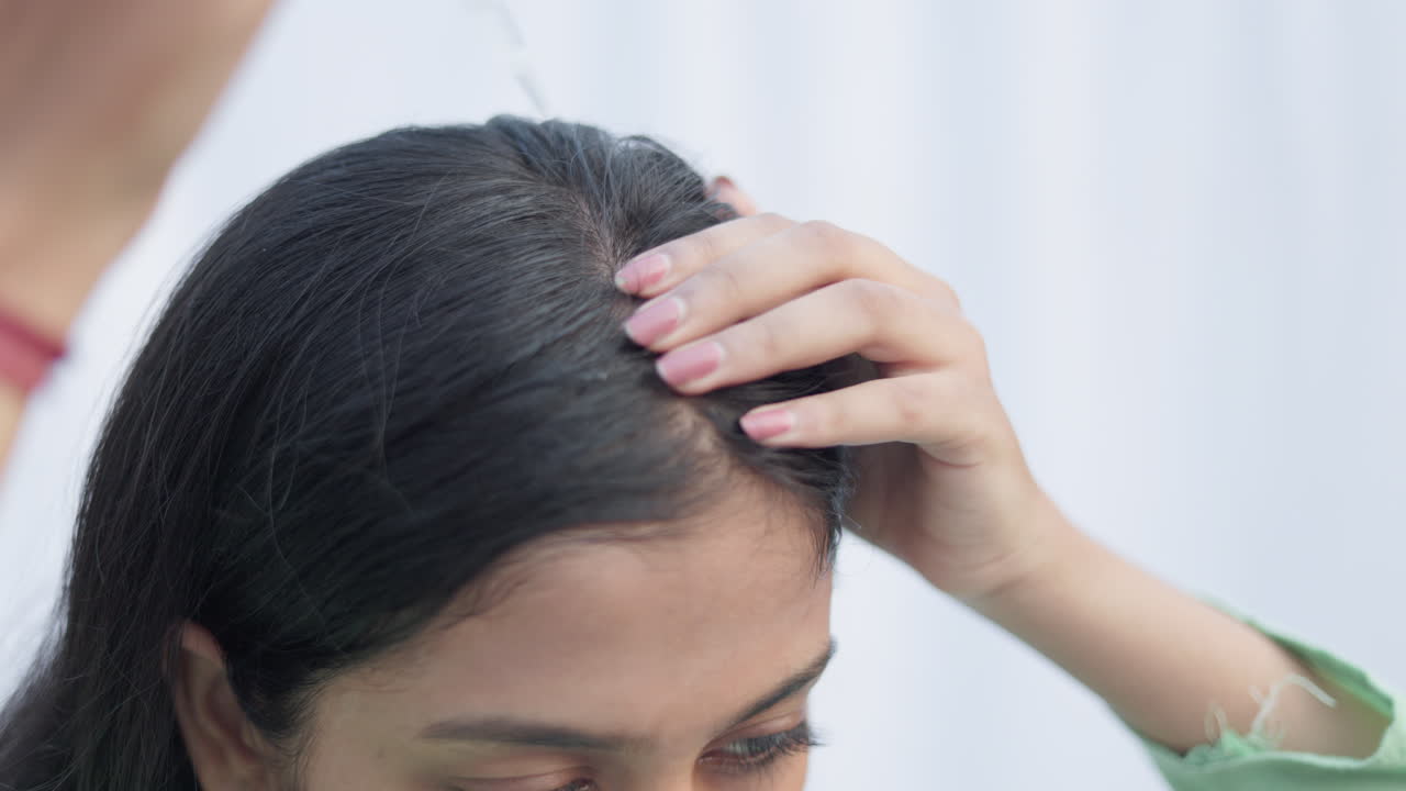 Close up shot of a woman applying minoxidil with a dropper on alopecia head for hairloss treatment.